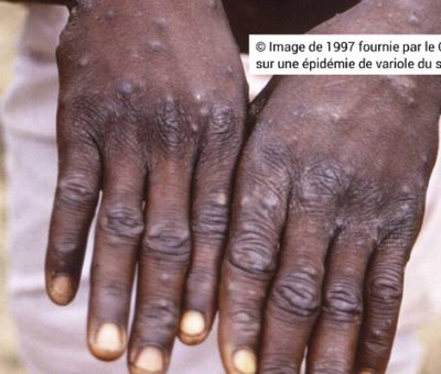© Image de 1997 fournie par le CDC lors d'une enquête sur une épidémie de variole du singe. — /AP/SIPA