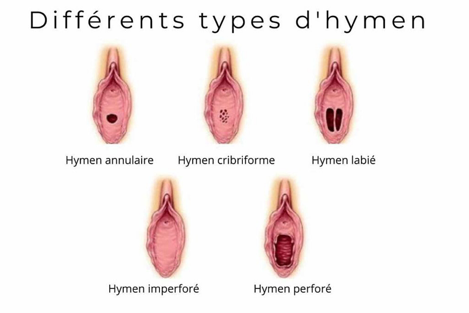 Différents type d'hymen
