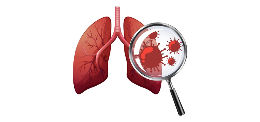 Tuberculose