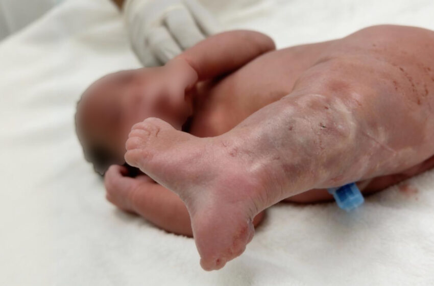 Sirenomélie à Limbé : comprendre une malformation rare au-delà des rumeurs et des croyances