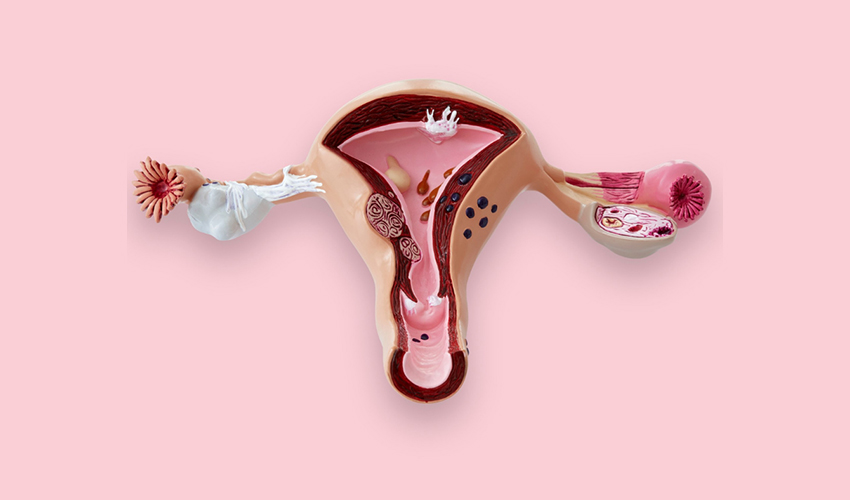  Le Syndrome des ovaires polykystiques (SOPK) change de nom : pourquoi ?