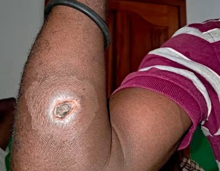 Grande-Anse : la maladie du charbon fait deux morts et inquiète les autorités sanitaires