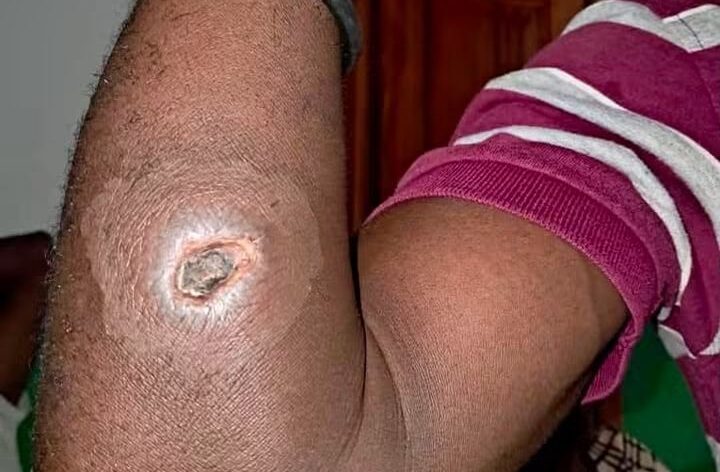 Grande-Anse : la maladie du charbon fait deux morts et inquiète les autorités sanitaires